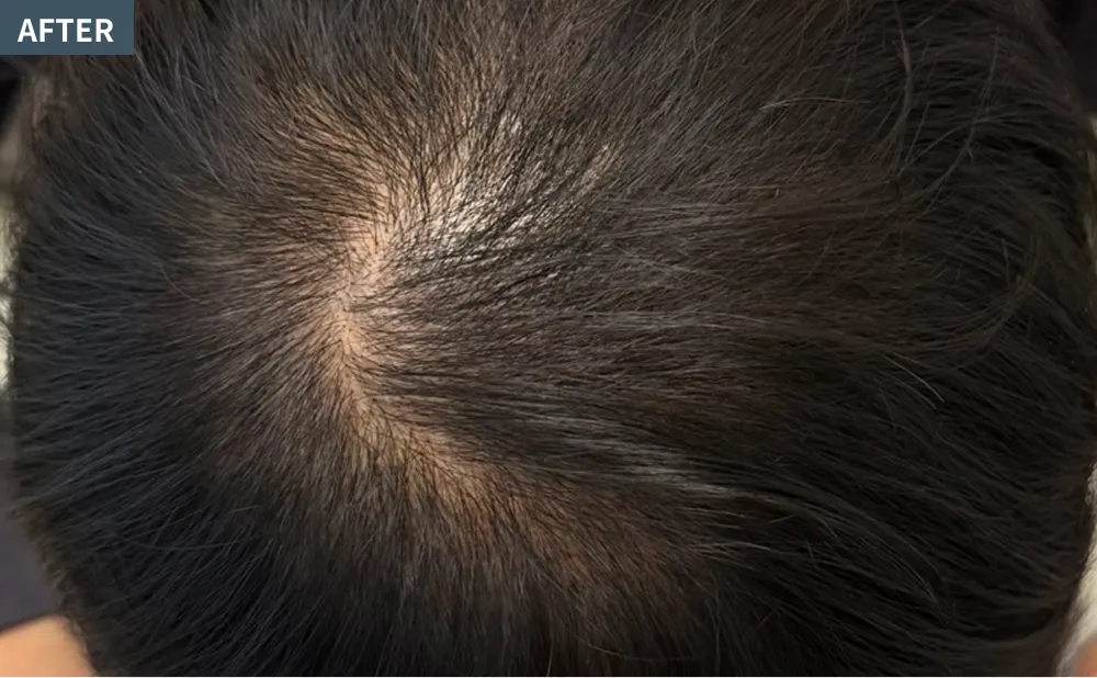 HANE scalp NORTHのエクソソームアフター