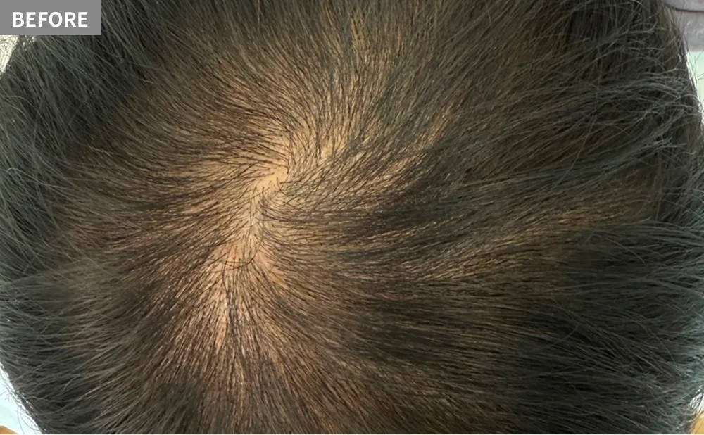 HANE scalp NORTHのエクソソームビフォー