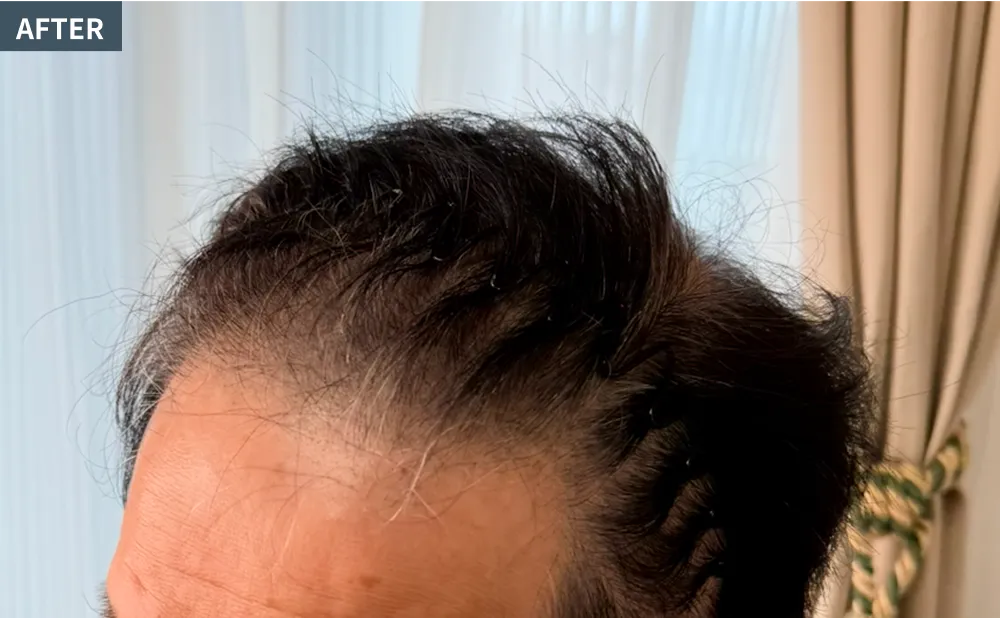 HANE scalp NORTHのヘアタトゥーアフター