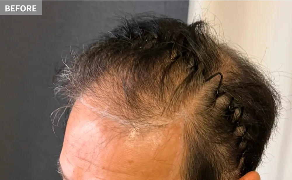 HANE scalp NORTHのヘアタトゥービフォー